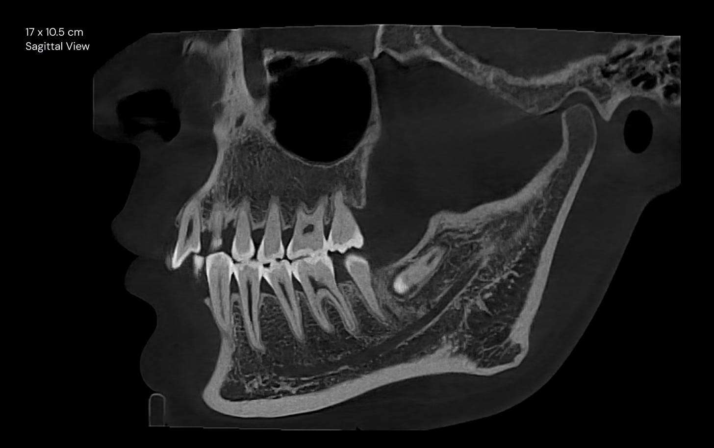 17 x 10.5 cm sagittal view